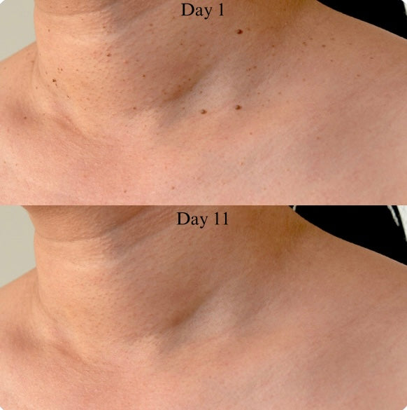 TagBuddy Kit™ - No More Skin Tags
